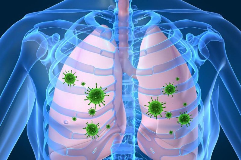 Viêm phổi do vi khuẩn
